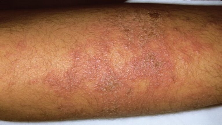 كيف نميز بين أعراض حساسية الطقس البارد ونزلات البرد؟