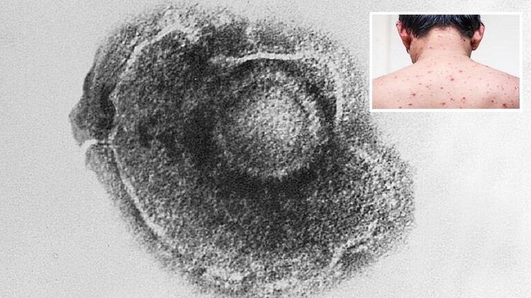 الصحة المصرية تكشف وضع “جدري القردة” في البلاد
