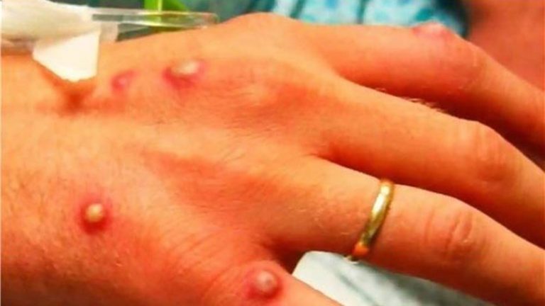 أكثر من 40 إصابة مؤكدة بـ “جدري القردة” في إسبانيا والبرتغال