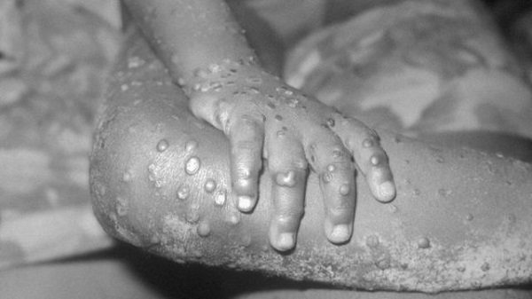 “جدري القرود” يواصل انتشاره