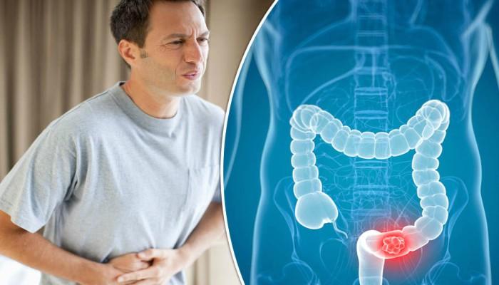 خطر الإصابة بسرطان القولون مرتبط بتناول اللحوم الحمراء