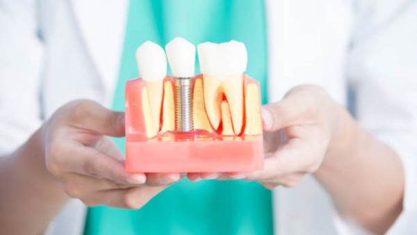 مُركّب نباتي أقوى من العظام يصلح لصنع غرسات الأسنان!