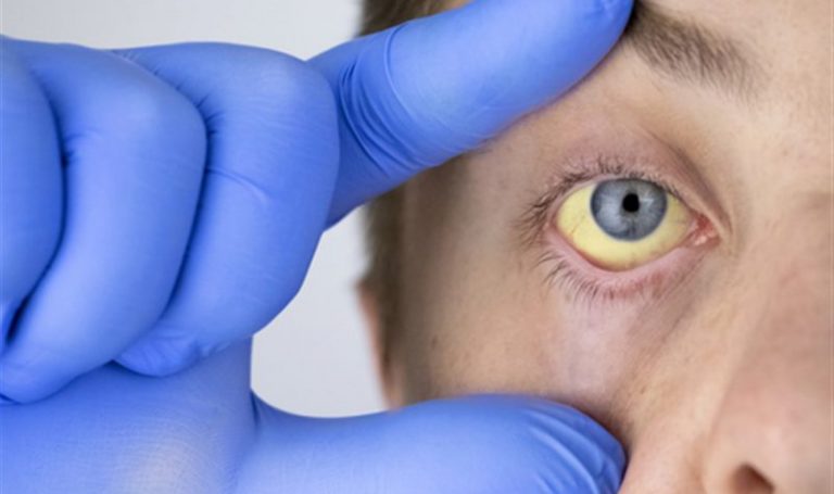 اليرقان سببه المياه الملوثة.. وهذه طرق الوقاية منه