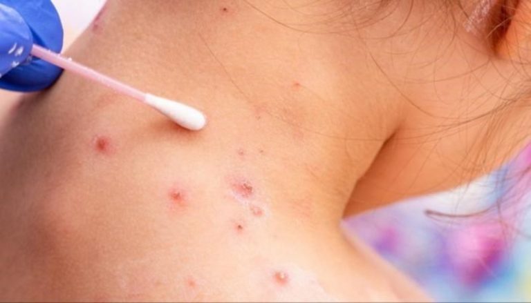 جدري القرود لا يمثل حالة طوارئ صحية شاملة