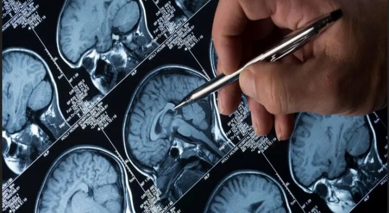 جينات جديدة وراء مرض التصلب الجانبي الضموري “ALS”