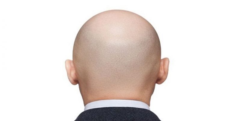 اكتشاف للعلماء: مادة يمكن أن تعالج الصلع!