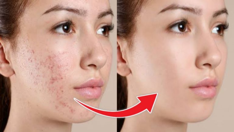 انتشار علاج جديد وفعال لحب الشباب!