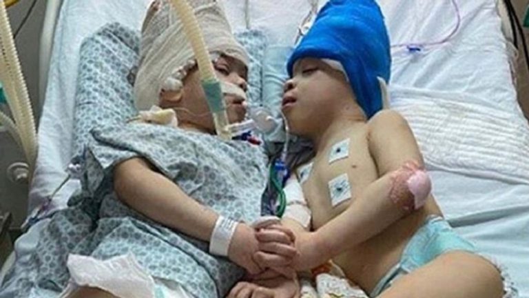 بالفيديو.. نجاح عملية فصل توأم برازيلي ملتصق الرأس