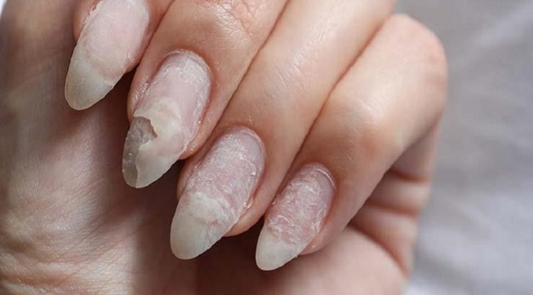 الأظافر قد تكشف الإصابة بالسكري
