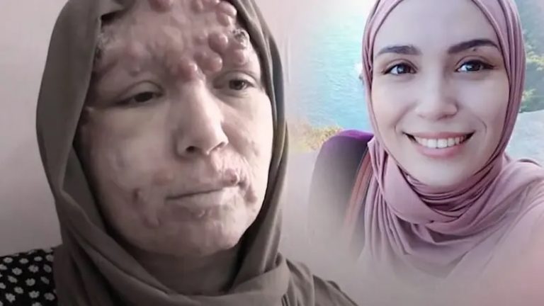 مرض نادر اصابها.. دمر حياتها وأدمت قصتها قلوب رواد التواصل!