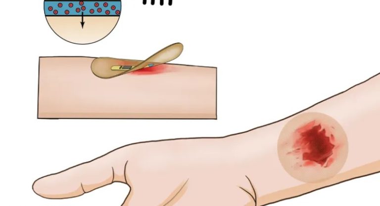 إنجاز طبي كبير.. ضمادة ذكية لها مفعول السحر مع الجروح