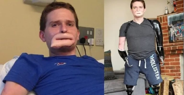 بكتيريا قاتلة ومرعبة.. بترت أطراف رجل وجعلته بفم غريب! (فيديو)