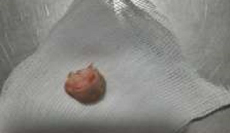 موظف يفقد إبهامه إثر عضة قوية من مسؤوله!