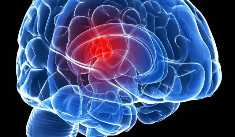 الأمل يعود لمرضى سرطان الدماغ.. لقاح جديد يقتل الأورام