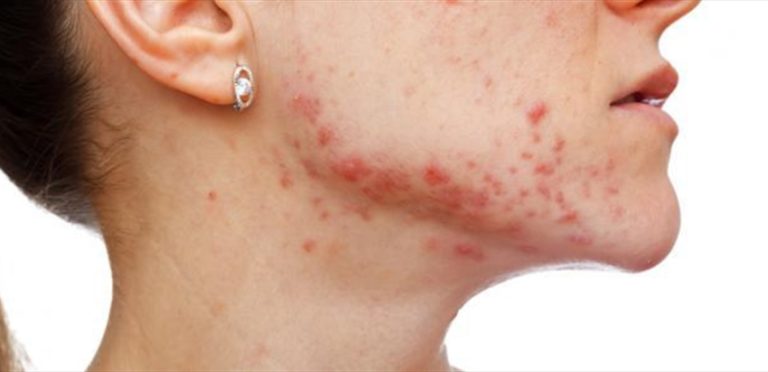 كيف يمكن مواجهة “حب الشباب” المزعج على الرقبة؟