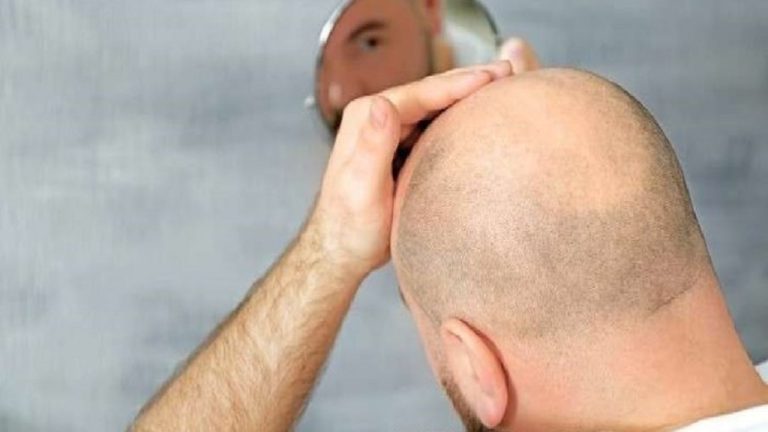 ما هي المشروبات التي يمكن أن تؤدي للصلع