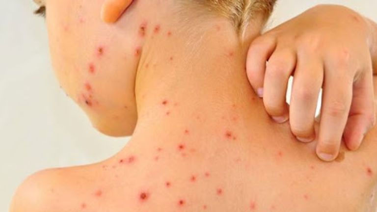 كيف تطور مرض الجدري عبر التاريخ؟