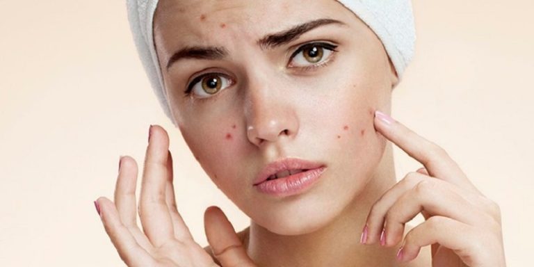 أطعمة تزيد من حب الشباب