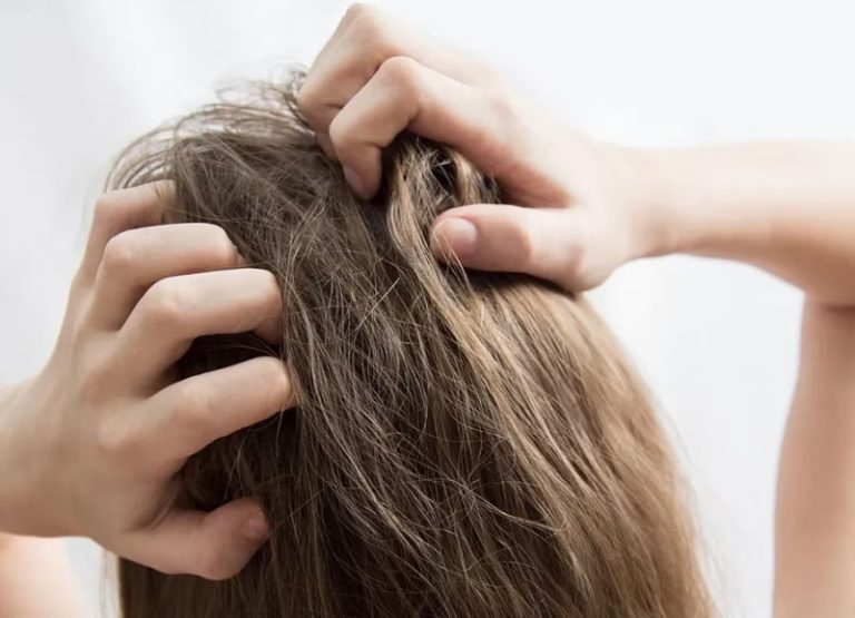 كيف يمكن معالجة فروة الرأس الحساسة؟