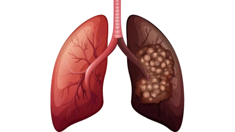 سرطان الرئة