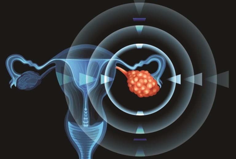 هذه العلامات تؤكد الإصابة بسرطان المبيض
