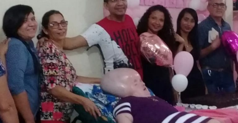 مرض غريب.. برازيلية تعاني من استمرار تضخم رأسها