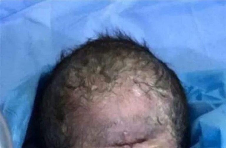 بالصورة.. ولادة طفل بعين واحدة