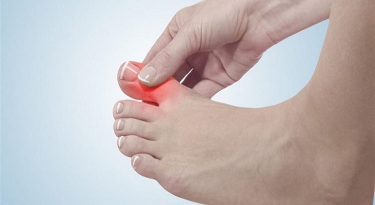 علامة في أصابع القدمين تنذر بارتفاع الكوليسترول