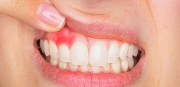 لإلتهاب الفم مخاطر كثيرة.. هذا ما ينصحه الأطباء