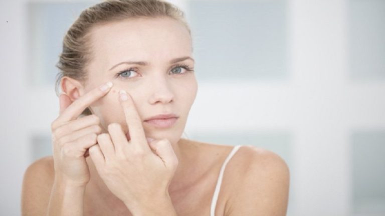 ما الذي يؤدي لظهور حب الشباب عند البالغين؟