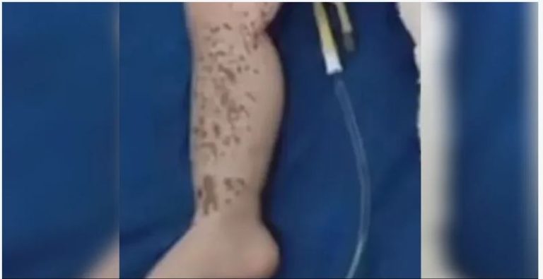 بين الحياة والموت.. غضب واسع بعد حرق طفلة بالأسيد!