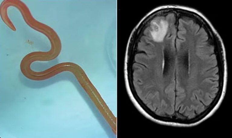دودة حية بطول 8 سم في دماغ امرأة!
