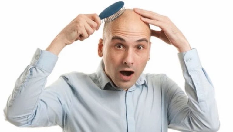 الصلع يقلق الرجال.. وهذا ترتيب الدول الأكثر عدداً بالصلعان!