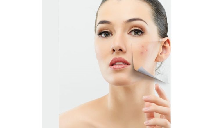 لماذا يسبب حب الشباب ندوباً؟