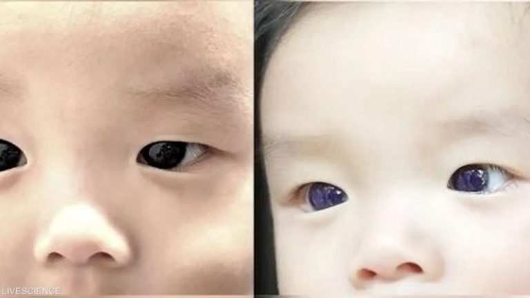 عينا رضيع تتحولان إلى الأزرق بسبب دواء!