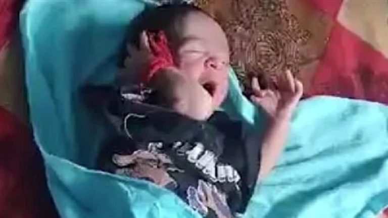 بالصور.. طفلة حديثة الولادة بـ26 إصبع!