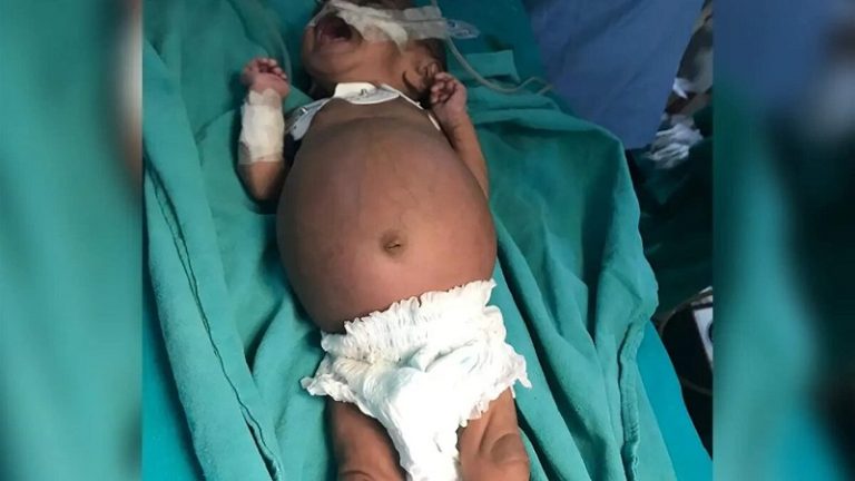 جنين داخل بطن طفلة!