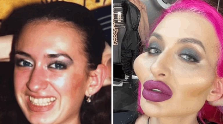 بالفيديو..نتيجة نفخ وجهها بال “فيليرز” بعد 6 سنوات!