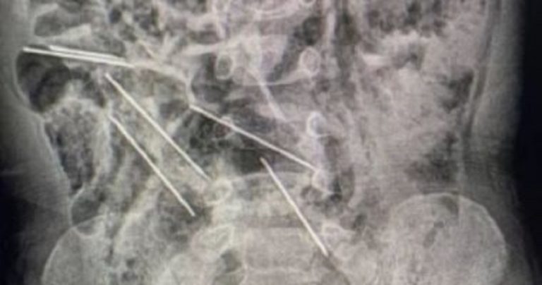 طفل يبتلع 8 إبر حقن!