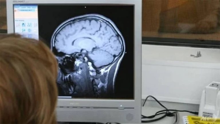 إبرة في دماغ امرأة منذ 80 عاماً!