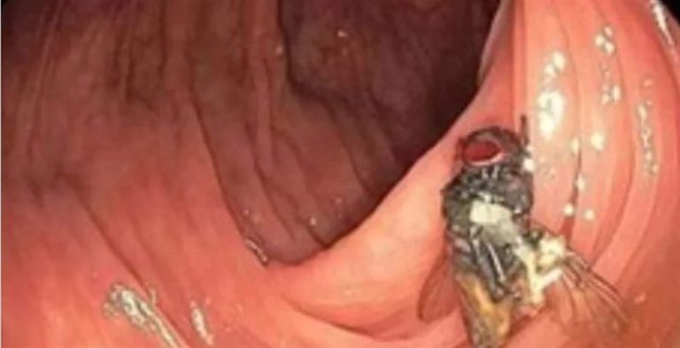حادثة غير مسبوقة.. ذبابة حية في إمعاء رجل!