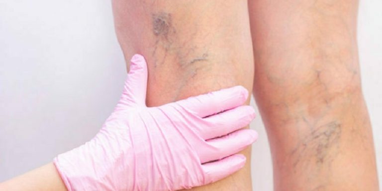 خطورة تمدد الأوعية الدموية!