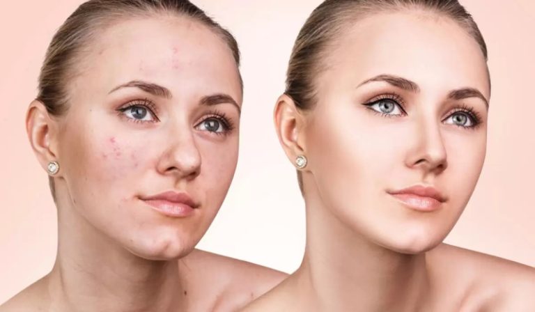 علاج جديد وسريع لأعراض حب الشباب!