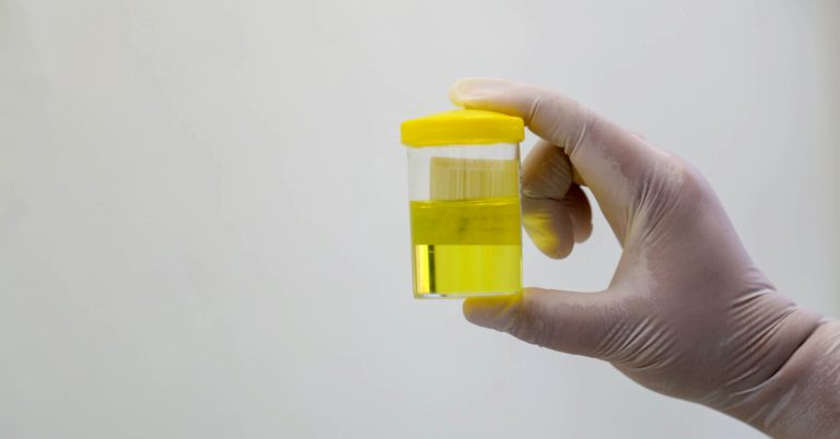 ما سبب تغير لون البول؟