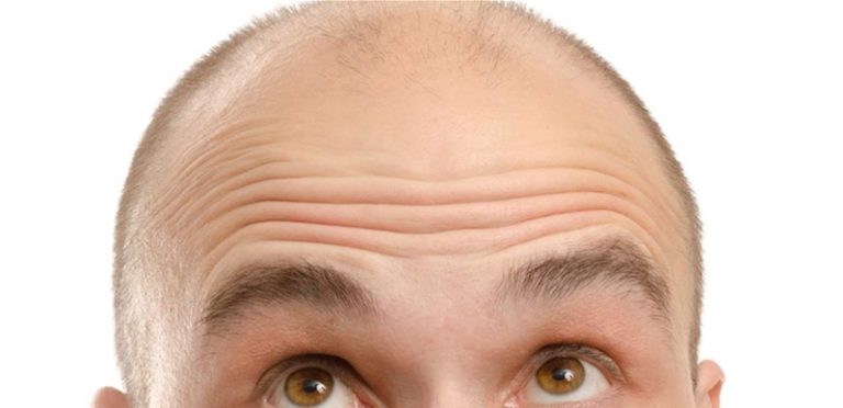 ما الذي يؤدي إلى الصلع المبكر عند الرجال؟