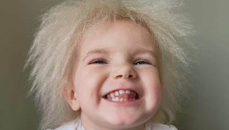 متلازمة “الشعر غير القابل للتمشيط”!