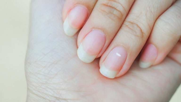 ماذا تعني العلامات البيضاء على الأظافر؟