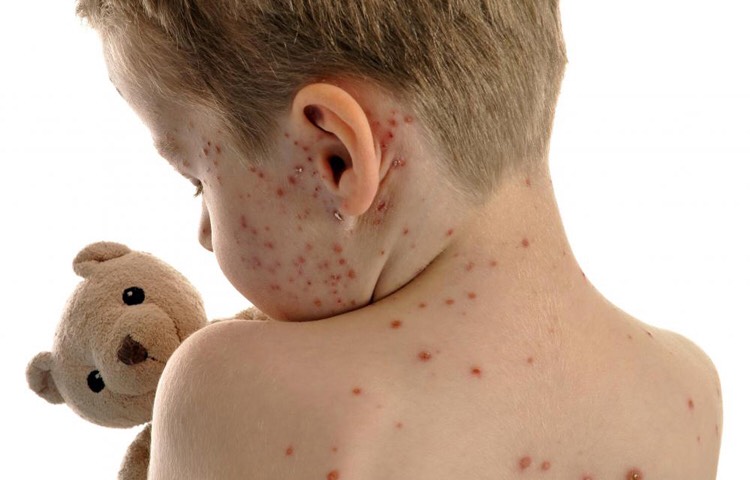 “الحصبة” تجتاح العراق!