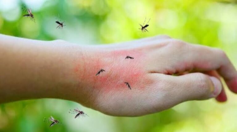أصيب بـ3 فيروسات من لدغة بعوضة!