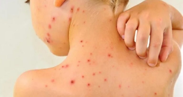 “جرب” و”جدري” في مدرسة حارة الناعمة!